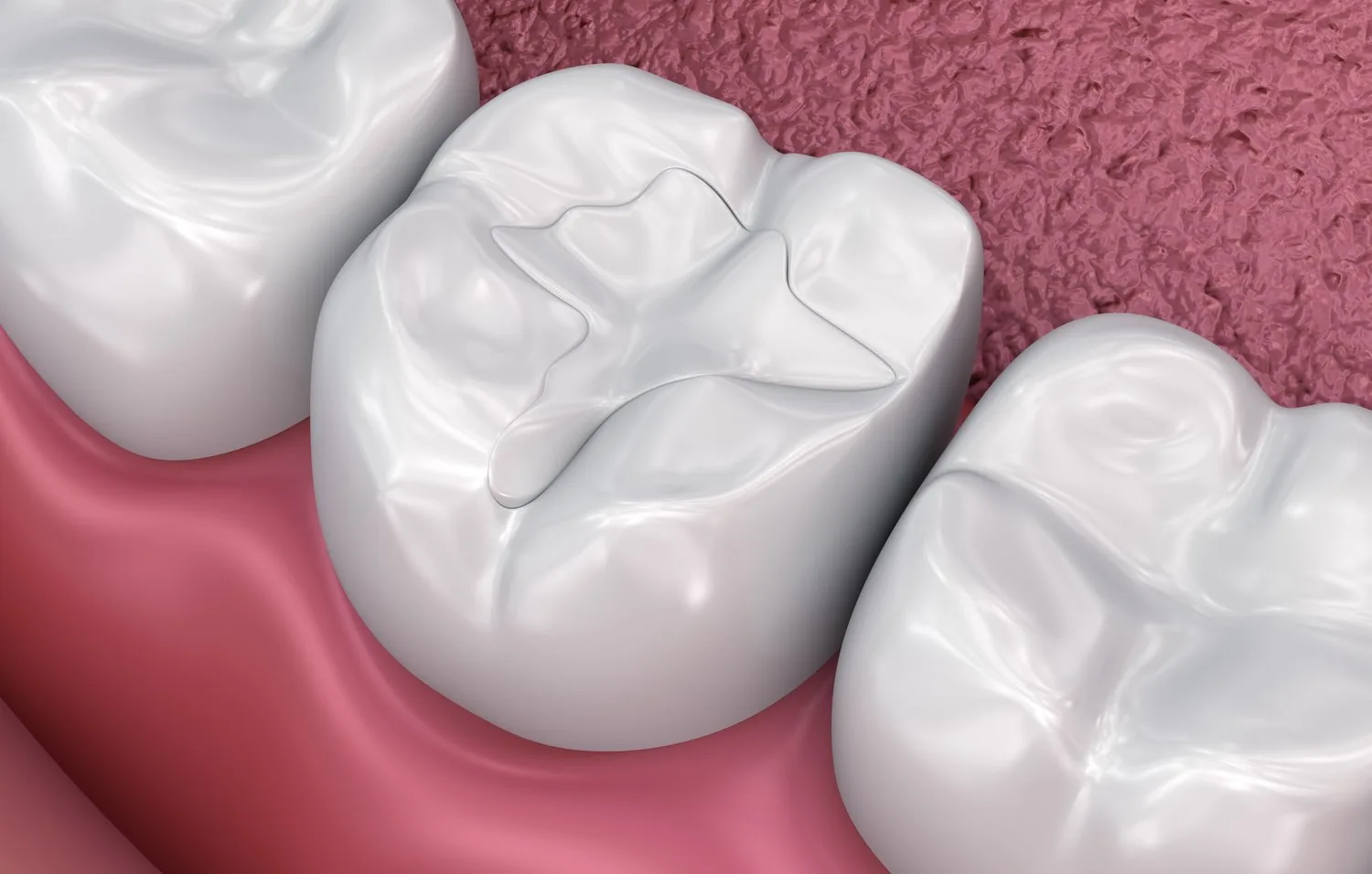 Tooth-colored composite filling on the chewing surface of a molar tooth.